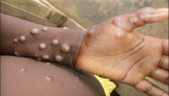 WHO approves first vaccine for monkeypox